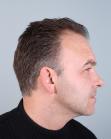 Before Hair Transplant&nbsp;Temporal Hairline
